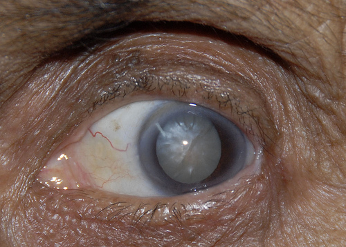 advanced cataract